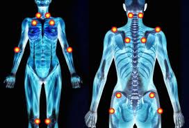 fibromyalgia tender points, x-ray showing tender points