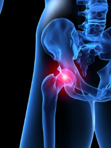 hip joint pain, 3d picture of hip joint, fibromyalgia hip pain